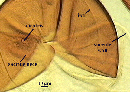Saccule wall iw1 saccule neck and cicatrix